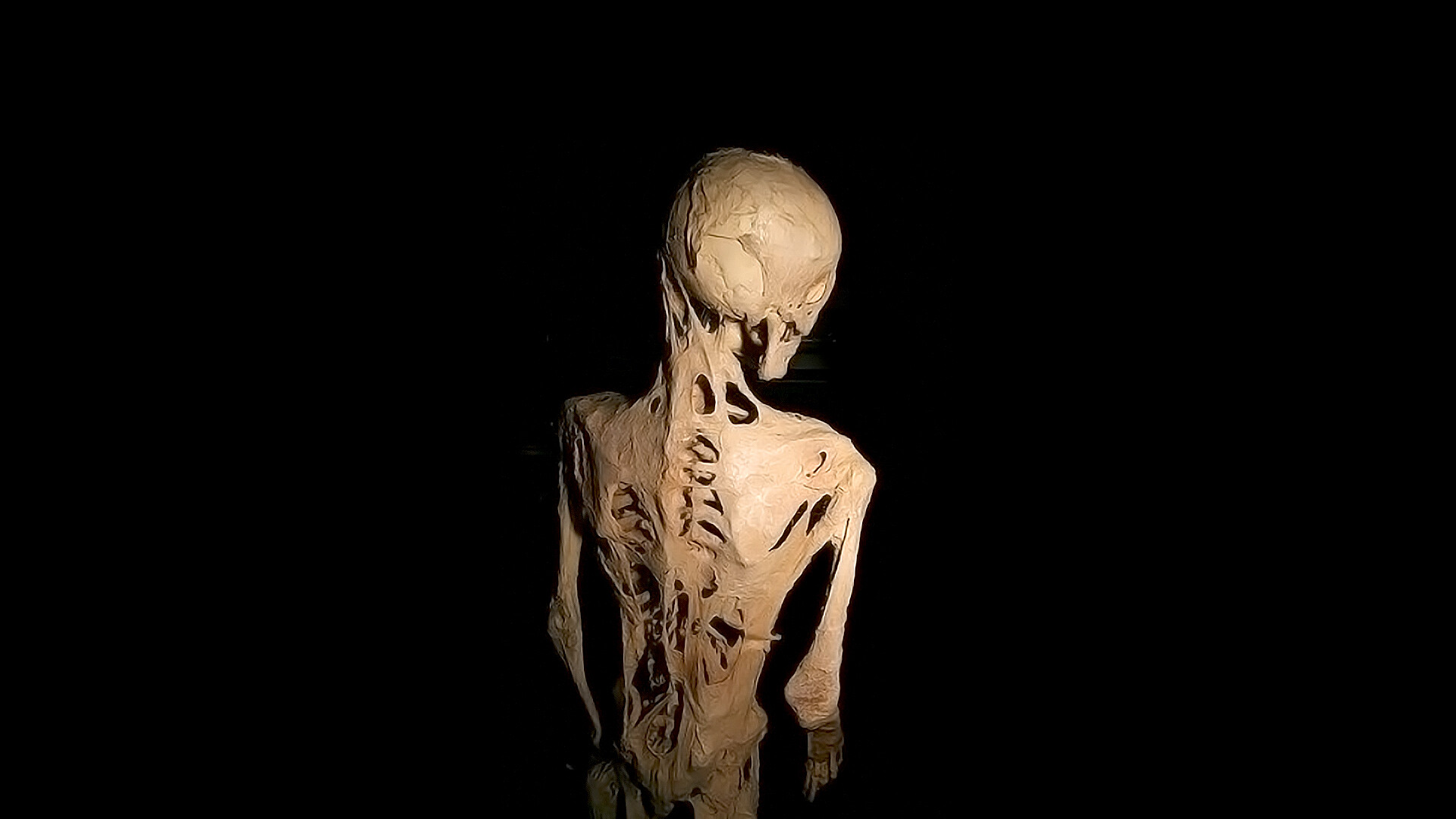 Fibrodisplasia Ossificante Progressiva (FOP)